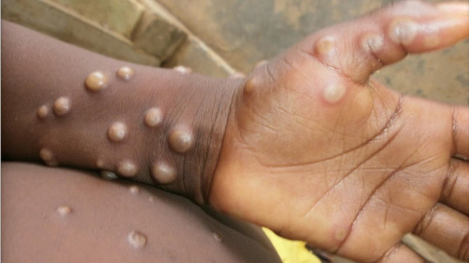 Ancaman Monkeypox Kini Dikesan Di 3 Negara Lagi!